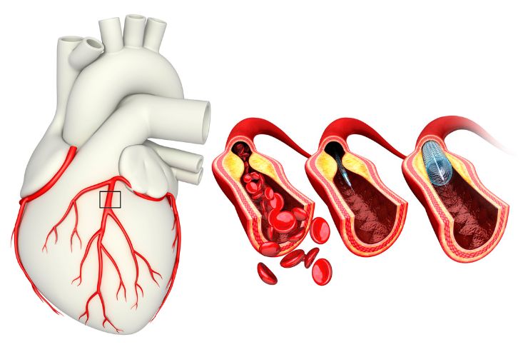 Coronary Artery Disease