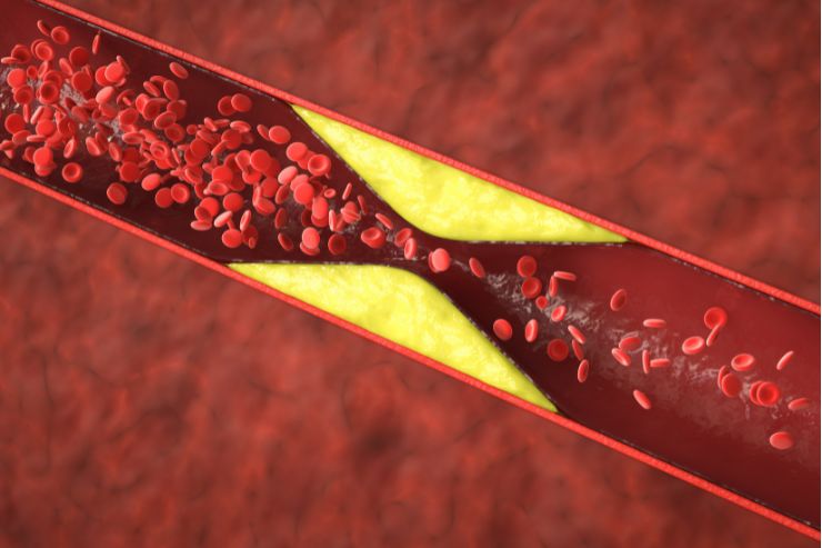 Hyperlipidemia